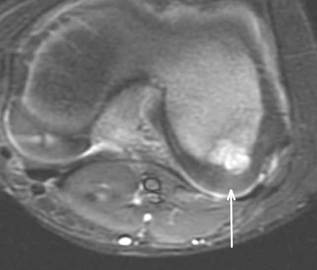 Figure 3 for case Staphylococcus osteomyelitis ( RID3715 )